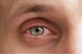 Hay Fever Effects On Eyes How To Deal With Hay Fever Eyes