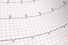 Langzeit Ekg Anlegen Was Sie Bei Einem Langzeit Ekg Beachten Sollten