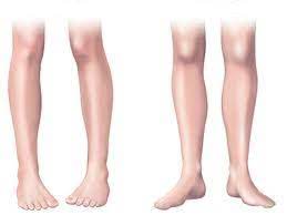 Traumatologia Y Ortopedia Infantil El Nino Mete Los Pies