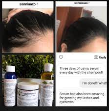 Hair oils aren't just for dry hair that's thick or curly. Formula D Extra Strength 3 Piece Kit Hair Restoration For Catastrophic Hair Loss Dandruff Severe Itching Patchy Bald Spots Receding Hairline
