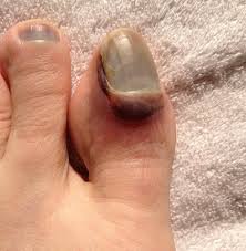 Maybe you would like to learn more about one of these? Toenail Blisters 7 Causes 7 Fixes Blister Prevention
