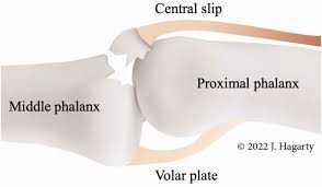 Image result for Lateral PIP Dislocation