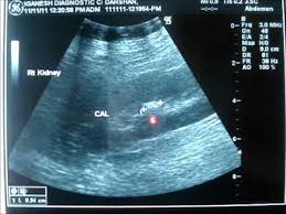 Ultrasound For Kidney Stone Youtube However, they can develop anywhere along your urinary tract, which consists of these parts ultrasound for kidney stone