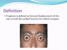 Image result for Proptosis