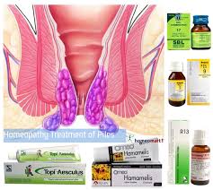 Piles Hemorrhoids Fissure Medicine In Homeopathy Homeopathy Homeopathy Medicine Hemorrhoids