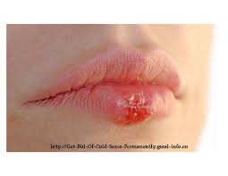 But you must consult a doctor first, especially if you have the. Recurring Cold Sores How To Get Rid Of Cold Sores How To Get Rid Of Cold Sores Overnight By Independent Issuu