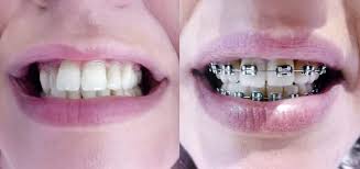1 Mes De Aparelho Dentario Blog Clinica Dentaria Dentya