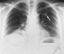Skull metastases have the same range of appearances as skeletal metastases elsewhere, and in 90% of cases other skeletal metastases are evident: Atypical Pulmonary Metastases Spectrum Of Radiologic Findings Radiographics