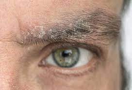 Low prices for health & beauty. How To Treat Dandruff On Eyelashes And Eyebrows