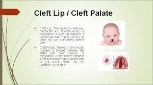 Birth Defects Shun Zhu Department Of Cellular And