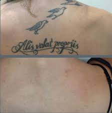 While having a tattoo removed is not as easy as having it placed, it can be done. Is Laser Tattoo Removal Worth The Cost