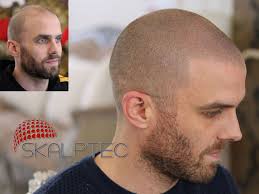 Ali safieddine leading the area for 7 years most successful procedure . Scalp Micropigmentation Uk Skalptec Best Smp Hair Loss Treatments