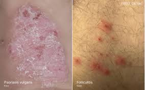 Image result for folliculitis symptoms
