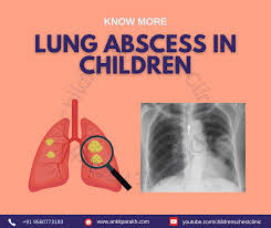 Image result for Lung Abscess