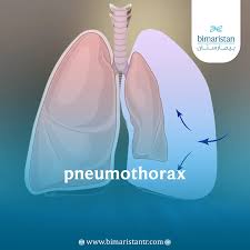 Image result for Pneumothorax