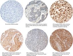 Join facebook to connect with kaiyan yanyan kok and others you may know. Shon Expression Predicts Response And Relapse Risk Of Breast Cancer Patients After Anthracycline Based Combination Chemotherapy Or Tamoxifen Treatment British Journal Of Cancer