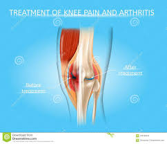 Knee Pain And Arthritis Treatment Vector Chart Stock Vector
