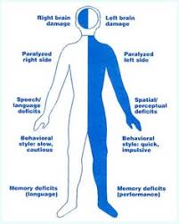 125 Best Stroke Images Stroke Recovery Stroke Association