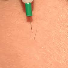 During the procedure, a very thin wire is inserted into the hair follicles underneath the skin surface. Faqs On Electrolysis Permanent Hair Removal At The Silver Filament