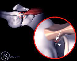 Internal Impingement Shoulder Elbow Orthobullets