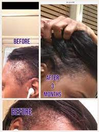 Stimulates new hair growth and can be used to treat androgenetic alopecia. Mega Growth Hair Elixir Oil Handmade Hair Growth With Organic Etsy Hair Elixir Hair Growth Kit Alopecia Hair Growth