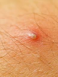 Terakhir yang menjadi penyebab timbulnya jerawat pada kulit badan adalah konsumsi obat tertentu. 9 Arti Letak Jerawat Di Tubuh Tunjukkan Masalah Kesehatan Hot Liputan6 Com