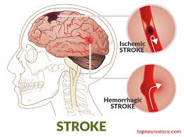 Get facts about stroke from the cdc. Stroke Cerebrovascular Accident Cva Top Neurodocs