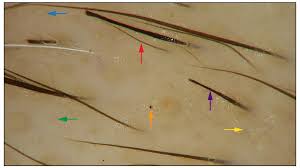 Check spelling or type a new query. The Value Of Dermoscopy In Diagnosing Eyebrow Loss In Patients With Alopecia Areata And Frontal Fibrosing Alopecia Waskiel Burnat 2019 Journal Of The European Academy Of Dermatology And Venereology Wiley Online Library