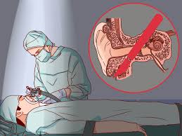 Image result for Bacterial Labyrinthitis