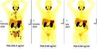 In most cases, prostate cancer is diagnosed before the cancer has spread to distant organs or bones. Early Treatment Of Advanced Prostate Cancer With Radioligand Therapy Prolongs Life Eurekalert Science News