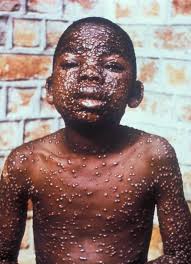 The disease affects a person when the virus transmits from. Smallpox Infectious Diseases Msd Manual Professional Edition