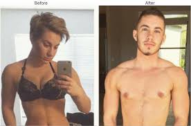 How female to male gender reassignment surgery worksmetatags;mesothelioma law firmdonate car to charity californiadonate car for tax creditdonate cars in mad. Growth Of Sex Reassignment Surgery Market Forecast To 2024 In