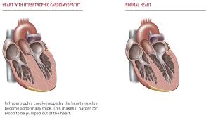 Image result for Cardiomyopathy