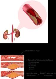 Goodman w.?g., goldin j., kuizon b.?d. Renal Artery Disease Elite Cardiovascular Group