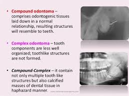 Dentaltown Odontoma Odontoma Also Termed Odontome Is A Benign Tumor Of Odontogenic Origin I E Linked To Tooth Development Oral Pathology Dental Teeth