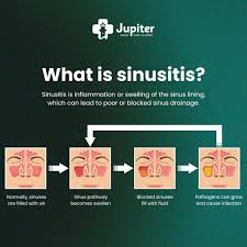 Image result for Sinusitis Prediction Rule