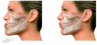 15 melhores ideias de Cirurgia ortognatica