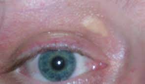 High Cholesterol Physical Examination Wikidoc