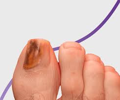 Image result for Pitting nails feet