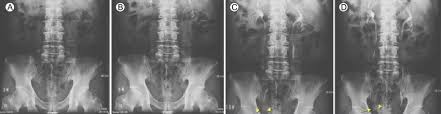 Image result for Intravenous Pyelogram