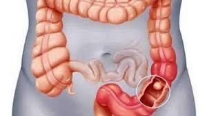 Durata medie de viata in functrie de raspandirea si statiul canceului la colon. Cancerul De Colon Simptomele Care Nu Trebuie Trecute Cu Vederea