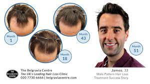 Последние твиты от belgravia centre (@belgraviacentre). Belgravia Male Hair Loss Treatment Success Story James Full Video Youtube