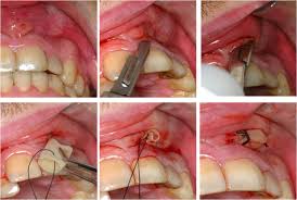 Image result for Periodontal Abscess