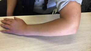 Medical center in châtelineau, hainaut, belgium. Cicatrice Apres Chirurgie Tendinite Tendons Epicondyliens Tennis Elbow Coude Paris Docteur Thomas Waitzenegger Chirurgie Epaule Chirurgie Main Chirurgie Coude Paris 16 Longjumeau Chirurgie Epaule Main Paris 91