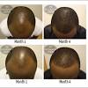 It is true that rogaine works for thinning hair. 1
