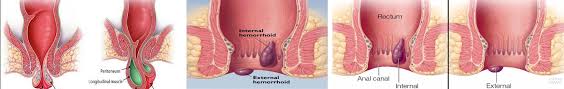Thrombosed hemorrhoids may present as a single lump or a circle of lumps. Thrombosed Hemorrhoid Treatment What Is External Causes Symptoms