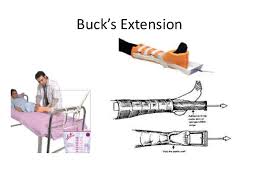 Of traction in which a nonconstricting boot with weights is worn by the pt to maintain proper alignment. Traction