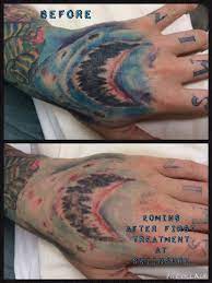 Experience The Best Tattoo Removal Method With The Experts Of Skiin Sure Tattoo Removal They Are Very Popular In Sydney Faded Tattoo Tattoo Removal Tattoos