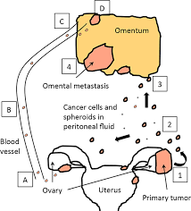 These mutations (called somatic mutations) accumulate during a. Ovarian Cancer Metastasis A Unique Mechanism Of Dissemination Intechopen
