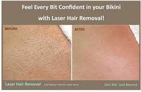 Laser hair removal, skin care, tattoo removal. Laser Hair Removal Plano Tx Frisco Tx